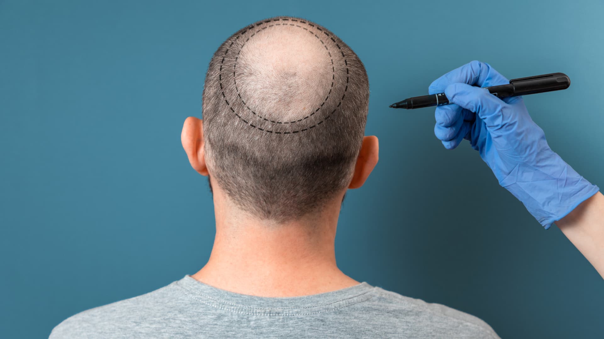 Prix Implants Capillaires : Méfiez-vous des Offres Trop Alléchantes